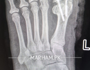 Post Operation X-ray