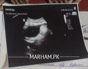 Heavy Vaginal Bleeding