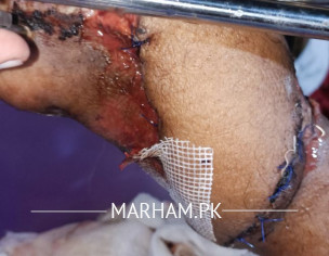 Limb Plastic Surgery