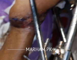 Limb Plastic Surgery