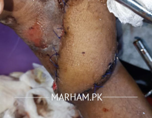 Limb Plastic Surgery