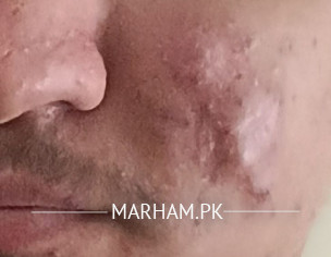 ACNE PROBLEM FOR FIVE YEARS