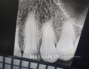 Teeth Root Canal