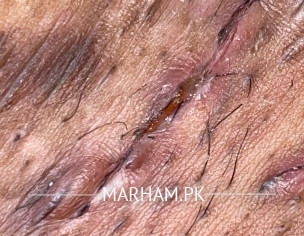 C Section Stitches 