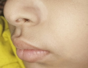 White Spot On Face Near Nore End