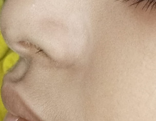 White Spot On Face Near Nore End