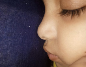 White Spot On Face Near Nore End