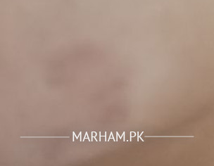 Post Hyperpigmentation Issue