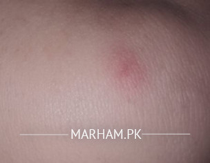 Allergy (dermatologist)