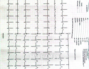 Ecg