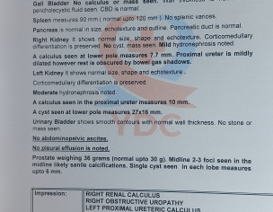 Kidney Stone In Both Sides