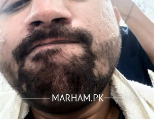 Hair Problems In Beard 
