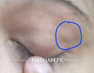Pimple In Eye
