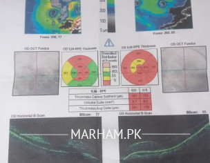 Sudden Blurred Vision
