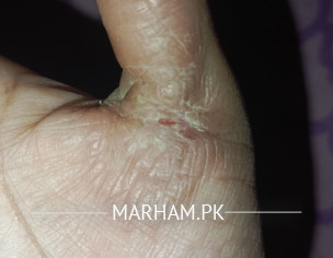 Diagnosed Eczema Psoriasis