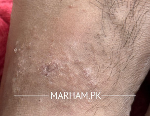 Itching Issue On Foot 