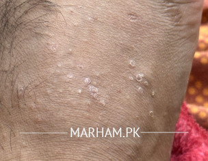 Itching Issue On Foot 