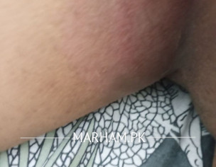 Rashes With Bleeding And Puss