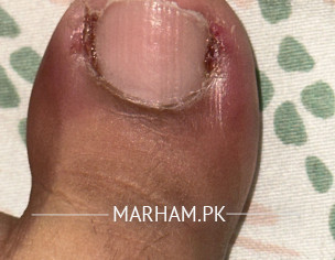 Toe Infection