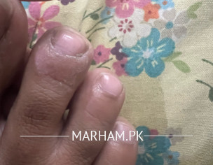 Itchy Tiny Pimples On Toe Fingers