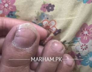 Itchy Tiny Pimples On Toe Fingers