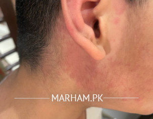 Redness Rash All Over Body