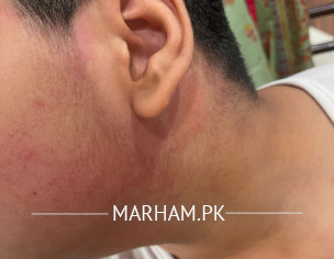 Redness Rash All Over Body