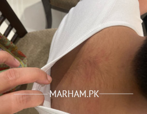 Redness Rash All Over Body