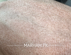 Skin Problem Xerosis