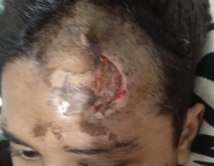 Open Wound Having Pus After Stitches