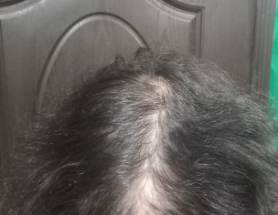 Thinning Hair