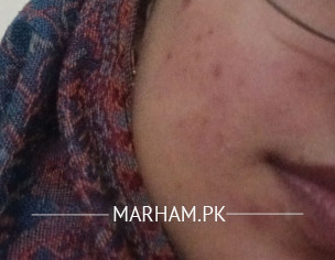 Acne And Peeling Skin