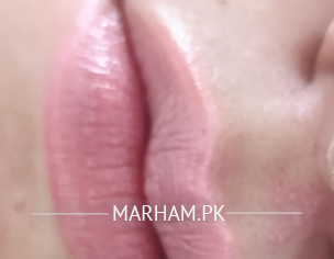 BURNT/ INFLAMMATION ON LIPS
