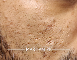 Ice Pick Scars And Open Pores