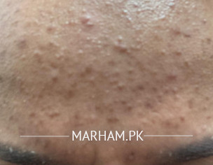 Acne On Forehead 