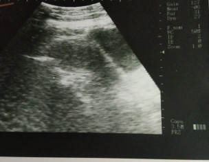 Pregnancy Is Exit Or Not