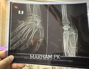 Fracture In Hand 