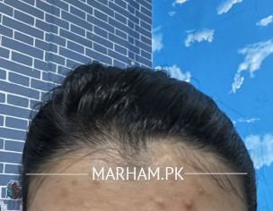 Acne , Lack Of Sleep 