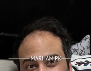 Baldness Hair Thinning