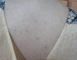 Pimples And Whiteheads