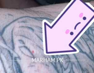 Monkey Rabies Bite In Thailand 