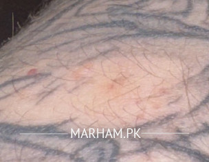 Monkey Rabies Bite In Thailand 