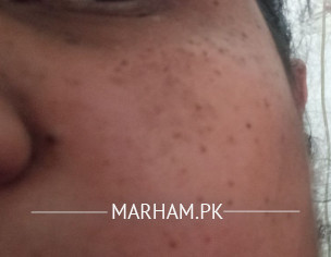 Pigmentation On Face