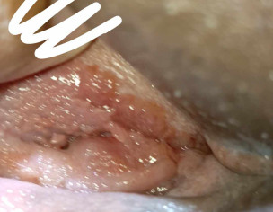 Vaginal Pain