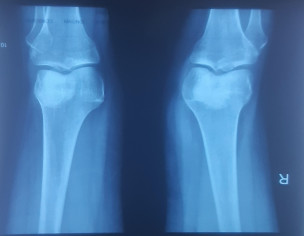 Knee Tibia Sprain Avulsion Fracture