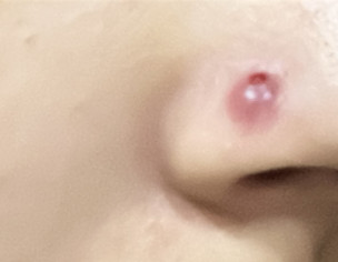 Nose Piercing Boil