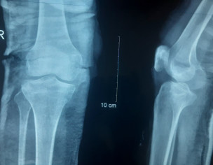 Knee Tibia Sprain Avulsion Fracture