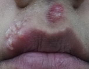 Blisters On Lips