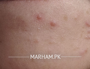 Reaction/ Dermatitis