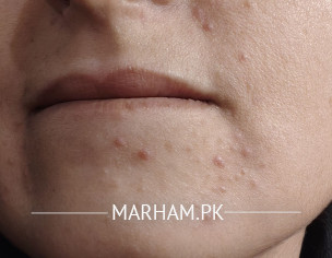 Reaction/ Dermatitis